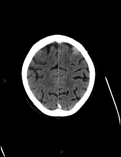 Cerebral metastases - ependymal and parenchymal (Radiopaedia 79877-93131 Axial C+ delayed 66).jpg