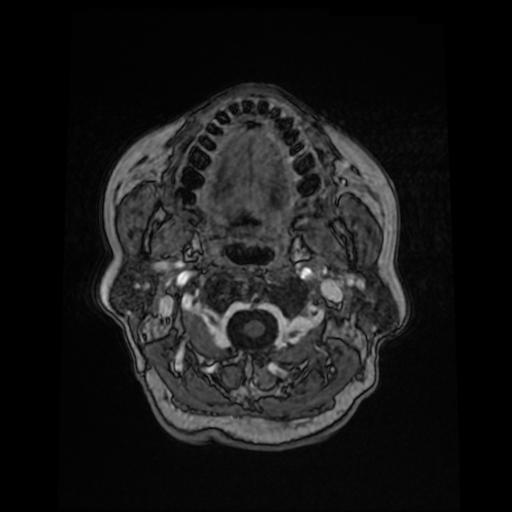 File:Cerebral metastases - melanoma (Radiopaedia 80972-94522 Axial T1 C+ 13).jpg