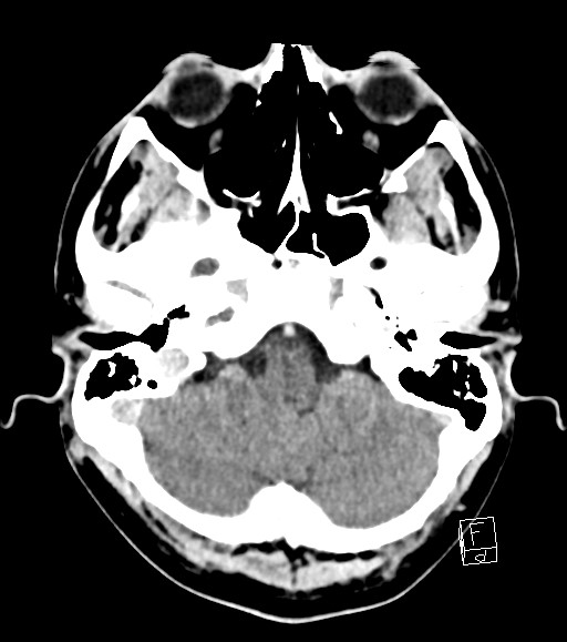 Cerebral metastases - testicular choriocarcinoma (Radiopaedia 84486-99855 Axial C+ delayed 45).jpg