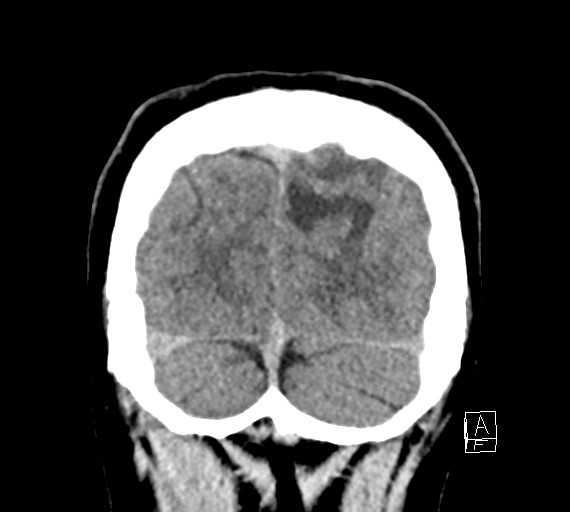 Cerebral metastases - testicular choriocarcinoma (Radiopaedia 84486-99855 Coronal C+ delayed 55).jpg