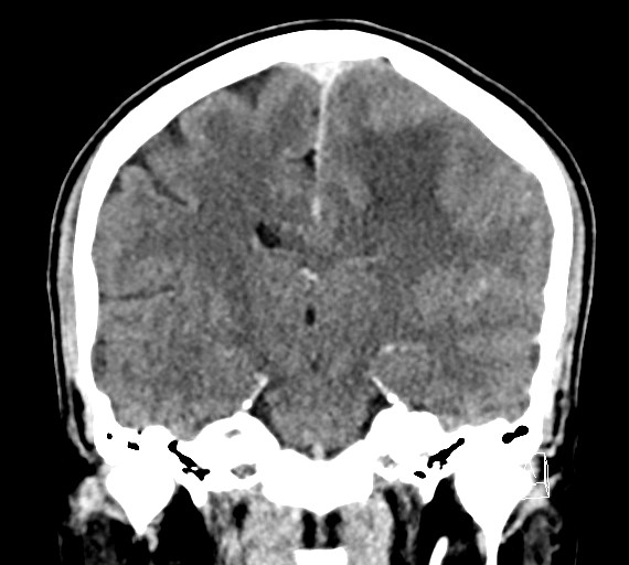 Cerebral metastases - testicular choriocarcinoma (Radiopaedia 84486-99855 D 34).jpg