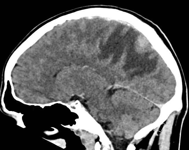 Cerebral metastases - testicular choriocarcinoma (Radiopaedia 84486-99855 F 27).jpg