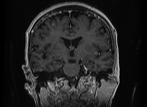 File:Cerebral metastases from lung cancer with amyloid angiopathy and cerebellopontine angle meningioma (Radiopaedia 74306-85191 Coronal T1 C+ 29).jpg