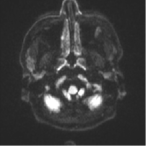 Cerebral metastasis - colorectal adenocarcinoma (Radiopaedia 50394-55765 Axial DWI 29).png
