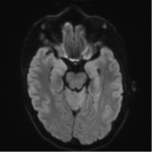 Cerebral metastasis - melanoma (Radiopaedia 54718-60954 Axial DWI 42).png