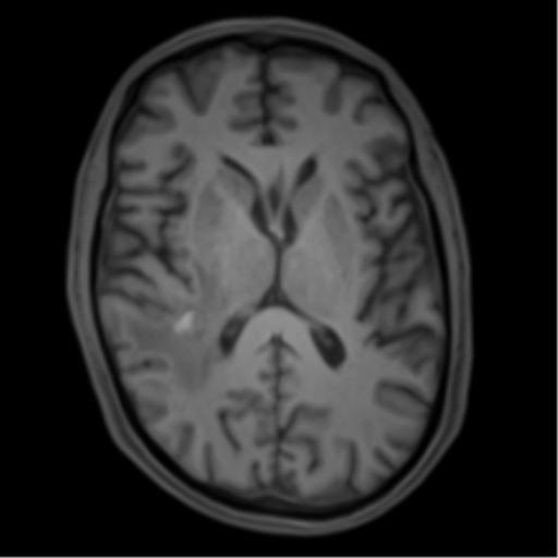 Cerebral metastasis - melanoma (Radiopaedia 54718-60954 Axial T1 29).png