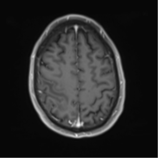 Cerebral metastasis - melanoma (Radiopaedia 54718-60954 Axial T1 C+ fat sat 42).png