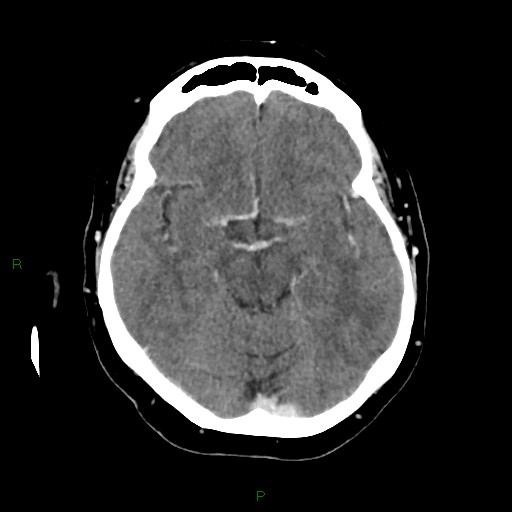 File:Cerebral metastasis from renal cell carcinoma (Radiopaedia 82306-96375 Axial C+ delayed 15).jpg