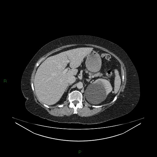 Cerebral metastasis from renal cell carcinoma (Radiopaedia 82306-96378 A 48).jpg