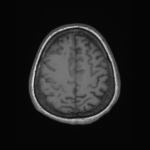 Cerebral metastasis to basal ganglia (Radiopaedia 81568-95413 Axial T1 59).png