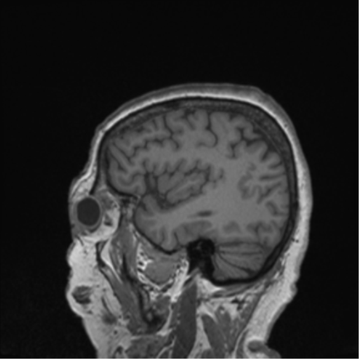 Cerebral metastasis to basal ganglia (Radiopaedia 81568-95413 Sagittal T1 14).png