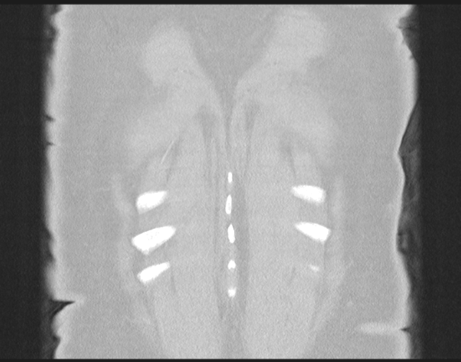 File:Cerebral metastasis to basal ganglia (Radiopaedia 81568-95414 Coronal lung window 78).png