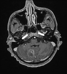 Cerebral toxoplasmosis (Radiopaedia 43956-47461 Axial T1 C+ 13).jpg
