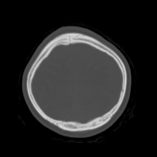 Cerebral tuberculosis with dural sinus invasion (Radiopaedia 60353-68018 Axial bone window 53).jpg