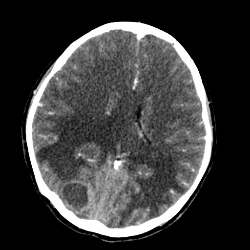 Cerebral tuberculosis with dural sinus invasion (Radiopaedia 60353-68019 Axial C+ delayed 38).jpg