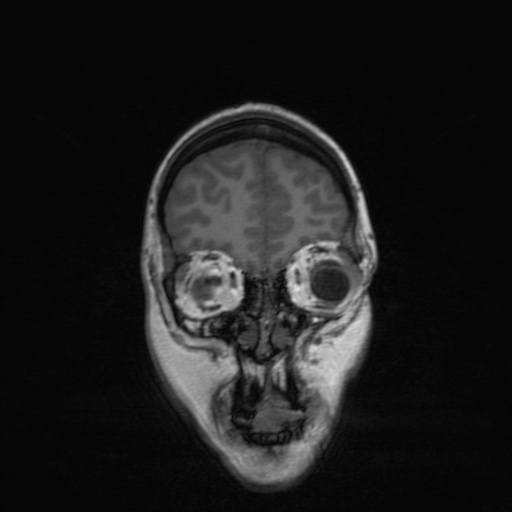 File:Cerebral tuberculosis with dural sinus invasion (Radiopaedia 60353-68090 Coronal T1 38).jpg