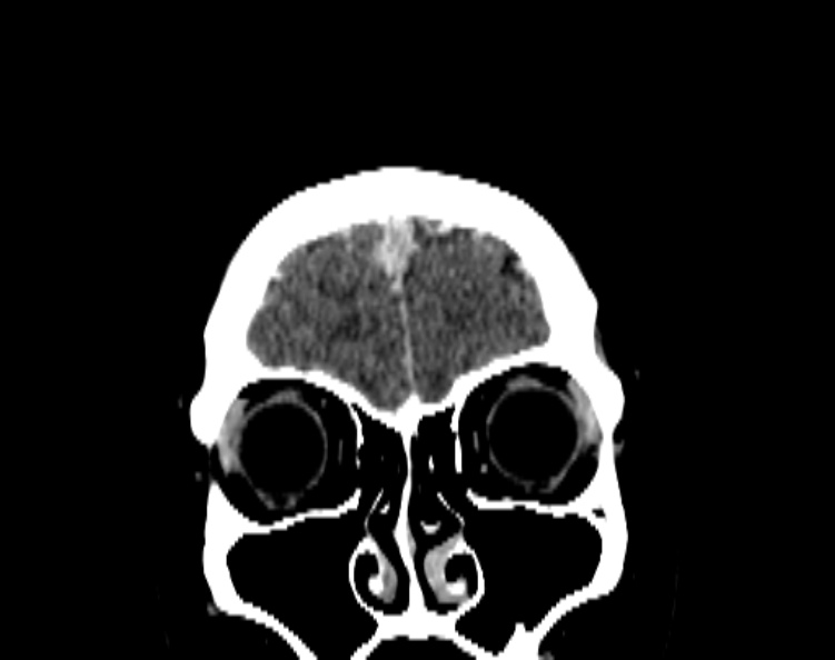 Cerebral venous hemorrhagic infarct from venous sinus thrombosis (Radiopaedia 55433-61883 Coronal C+ delayed 15).jpg