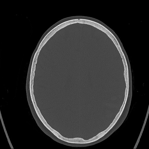 Cerebral venous infarction with hemorrhage (Radiopaedia 65343-74381 Axial bone window 120).jpg