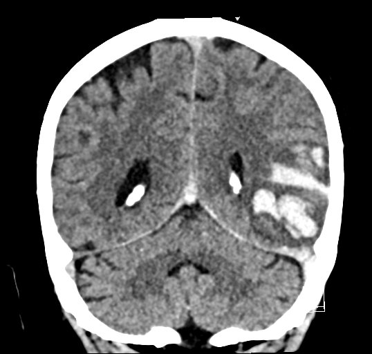 Cerebral venous infarction with hemorrhage (Radiopaedia 65343-74381 Coronal non-contrast 39).jpg