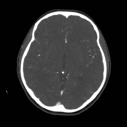 Cerebral venous sinus thrombosis (Radiopaedia 40619-43227 A 109).jpg