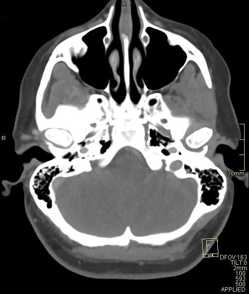 Cerebral venous sinus thrombosis (Radiopaedia 91329-108965 Axial venogram 18).jpg