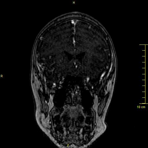 Cerebral venous thrombosis (Radiopaedia 23288-23351 MRV 30).JPG