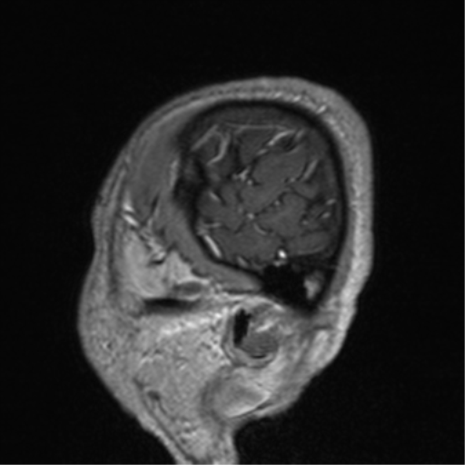 File:Cerebral venous thrombosis (Radiopaedia 38392-40469 Sagittal T1 C+ 79).png