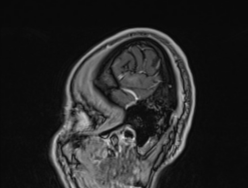 Cerebral venous thrombosis (Radiopaedia 71207-81504 Sagittal T1 C+ 2).jpg