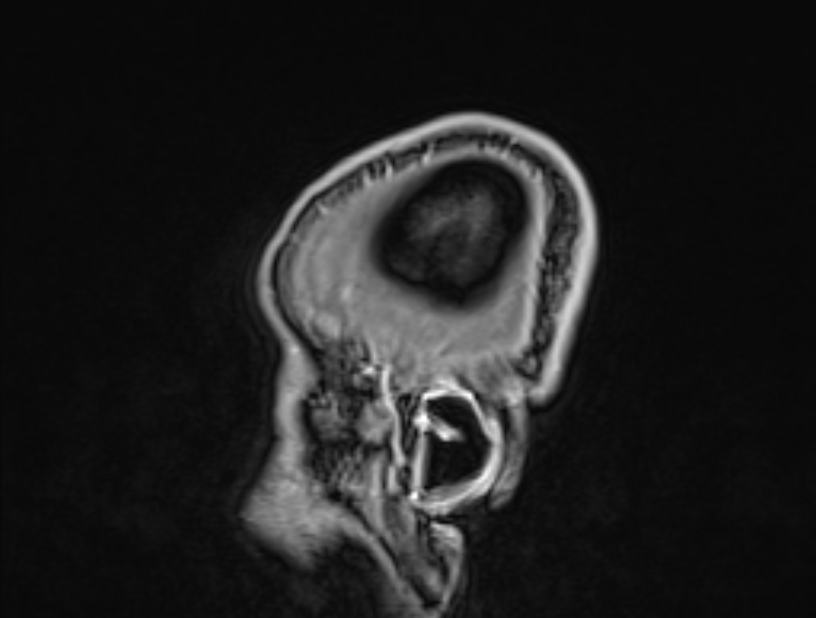 Cerebral venous thrombosis (Radiopaedia 71207-81504 Sagittal T1 C+ 63).jpg