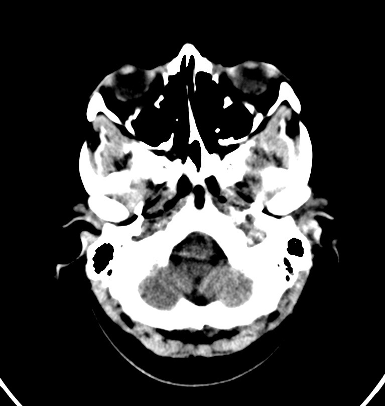 Cerebral venous thrombosis - CT only (Radiopaedia 41031-43778 Axial non-contrast 77).jpg