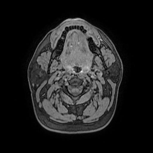 File:Cerebral venous thrombosis with secondary intracranial hypertension (Radiopaedia 89842-106957 Axial T1 C+ 2).jpg
