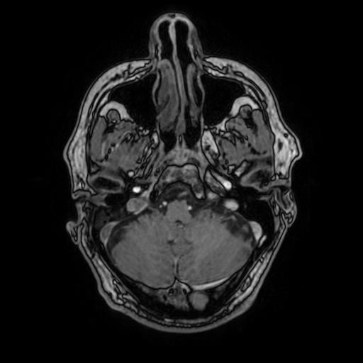 File:Cerebral venous thrombosis with secondary intracranial hypertension (Radiopaedia 89842-106957 Axial T1 C+ 48).jpg