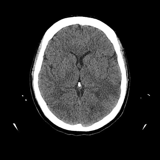 Cerebral venous thrombosis with venous hemorrhagic infarct (Radiopaedia 90354-107660 Axial non-contrast 26).jpg