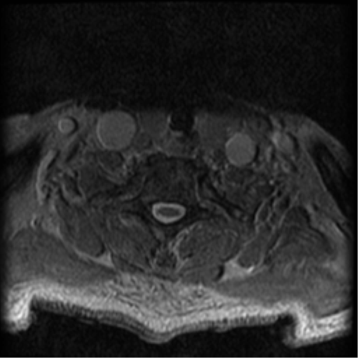 File:Cervical canal stenosis with cord compression (Radiopaedia 34114-35374 Axial Gradient Echo 17).png