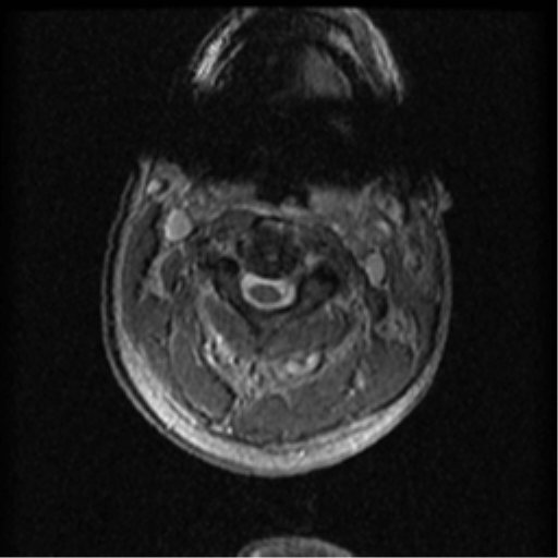 File:Cervical canal stenosis with cord compression (Radiopaedia 34114-35374 Axial Gradient Echo 76).png