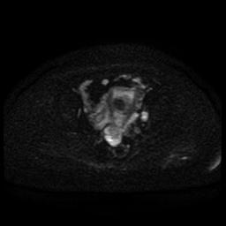 Cervical carcinoma (Radiopaedia 85405-101028 Axial DWI 51).jpg