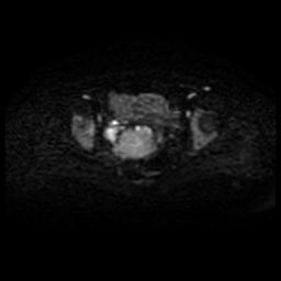 Cervical carcinoma (Radiopaedia 88010-104555 Axial DWI 30).jpg