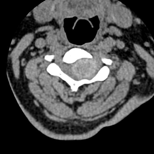 File:Cervical spinal neurofibroma in a patient with NF1 (Radiopaedia 58344-65464 Axial non-contrast 33).jpg