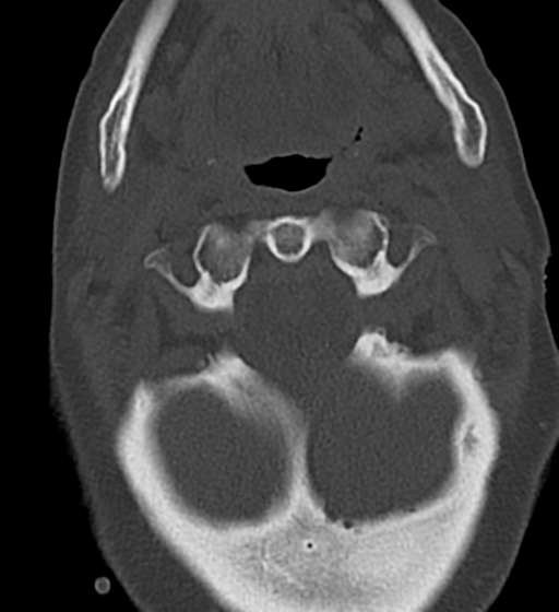 Cervical spine ACDF loosening (Radiopaedia 48998-54070 Axial bone window 15).png
