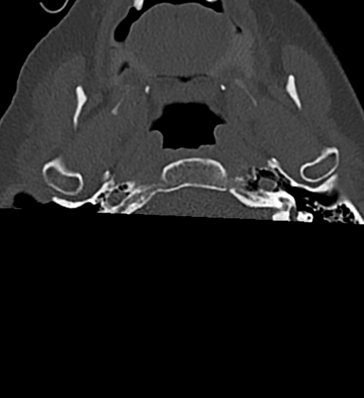 File:Cervical spine ACDF loosening (Radiopaedia 48998-54070 Axial bone window 3).png