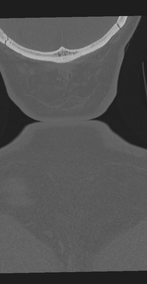 Cervical spine fracture in the setting of ankylosis (Radiopaedia 37038-38715 Coronal bone window 79).png