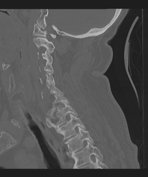 Cervical spine fracture in the setting of ankylosis (Radiopaedia 37038-38715 Sagittal bone window 50).png