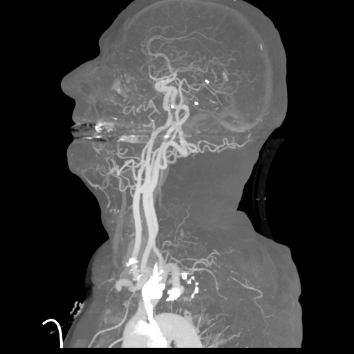 File:Cervical spine fractures with vertebral artery dissection (Radiopaedia 53296-59269 3D MIP 17).png