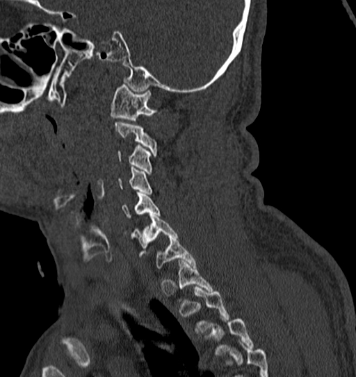 File:Cervical spine trauma with tear drop fracture and perched facet joint (Radiopaedia 53989-60127 Sagittal bone window 39).jpg