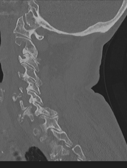 Cervical spondylolysis (Radiopaedia 49616-54811 Sagittal bone window 48).png