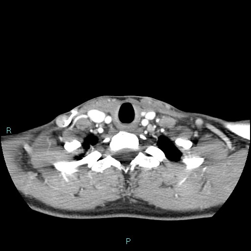 Cervical thymic cyst (Radiopaedia 88632-105335 B 35).jpg