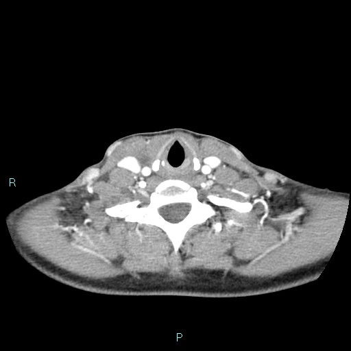 Cervical thymic cyst (Radiopaedia 88632-105335 B 41).jpg