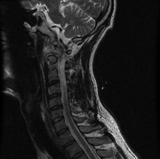 File:Cervical vertebrae metastasis (Radiopaedia 78814-91667 Sagittal T2 8).png