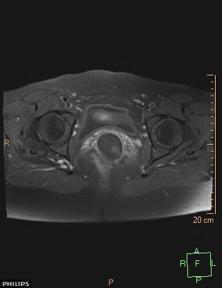 File:Cesarian scar endometriosis (Radiopaedia 68495-78066 Axial T1 C+ fat sat 19).jpg