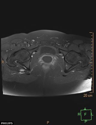 File:Cesarian scar endometriosis (Radiopaedia 68495-78066 Axial T1 C+ fat sat 21).jpg